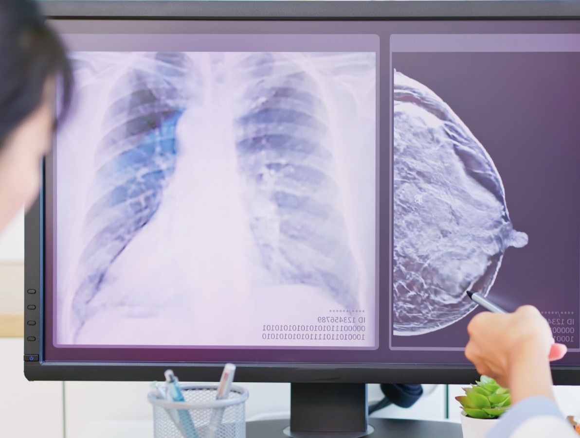 doctor explaining patient's breast mammogram results