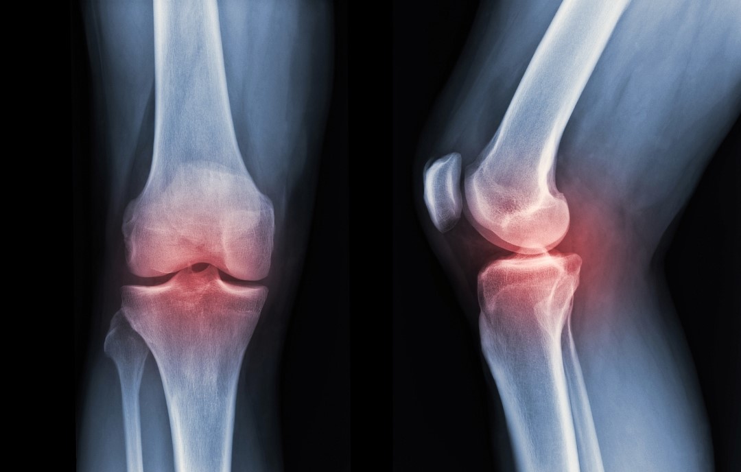 xray of knee