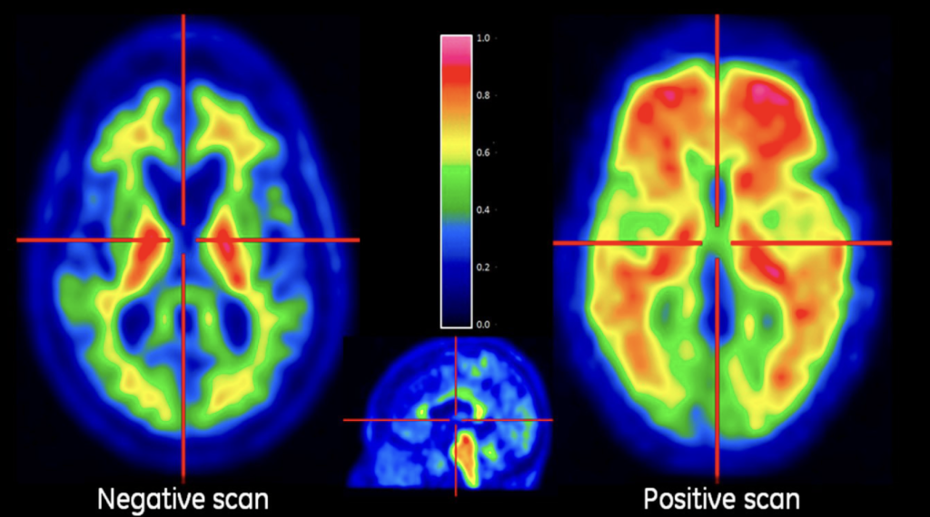 Amyloid PET Scan showing plaques