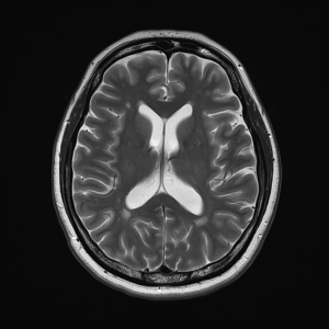 Amyloid brain PET scan