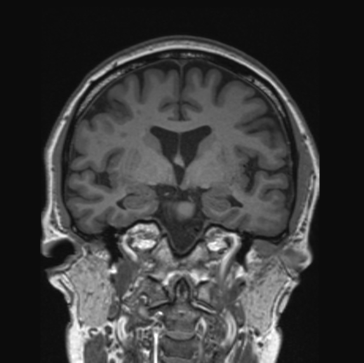Amyloid PET scan