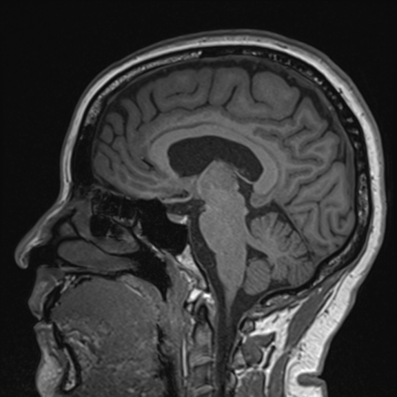 Amyloid PET scan brain